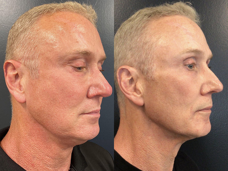 Before and After Image: Morpheus8 NYC - right-side