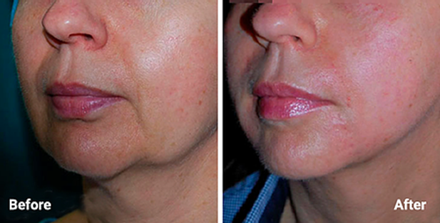 Before and After Image: Morpheus8 NYC - front