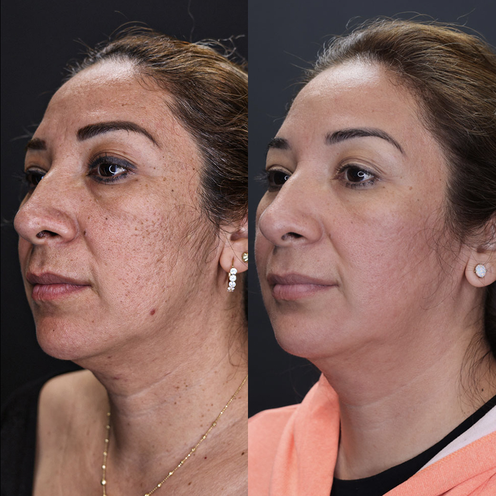 Before and After Image: Morpheus8 NYC - left-front-oblique