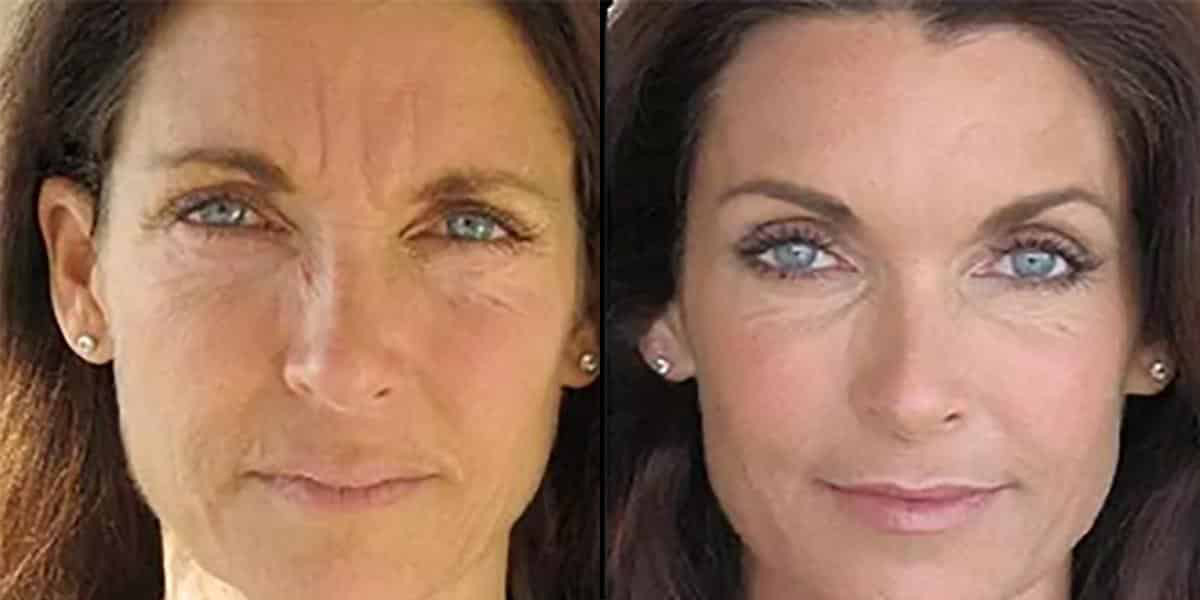 Before and After Image: Photofacial - front