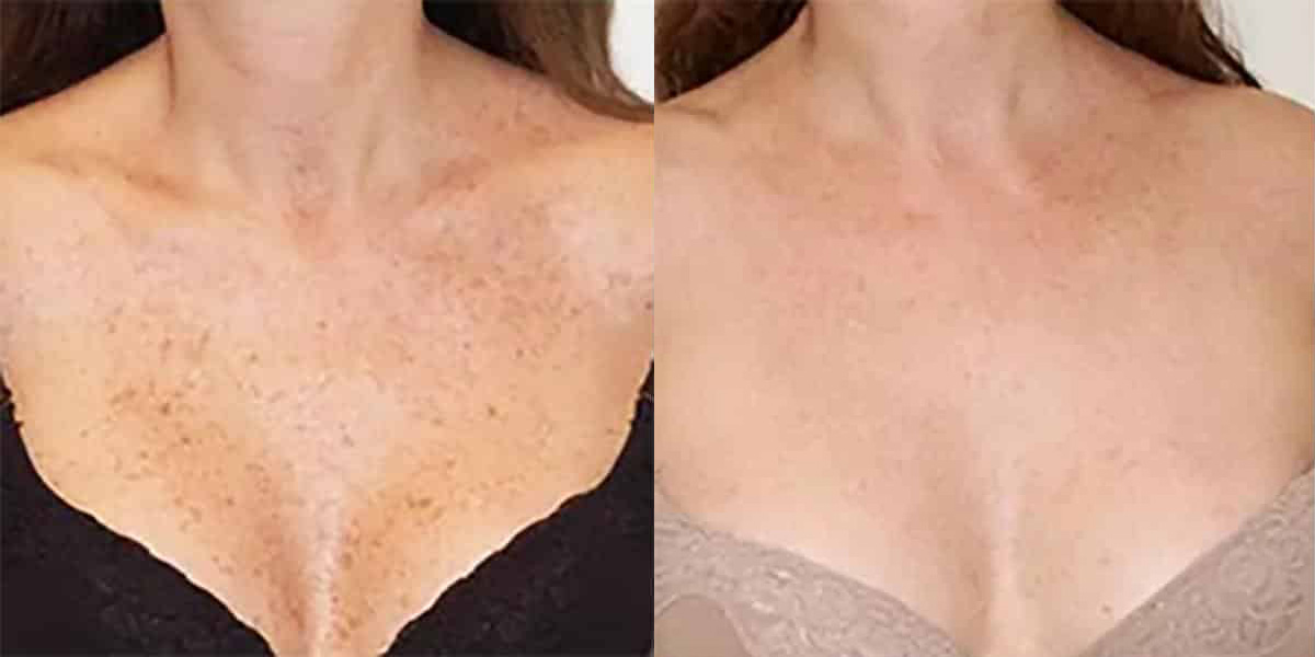 Before and After Image: Photofacial - front