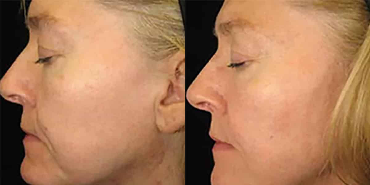 Before and After Image: Photofacial - left-side