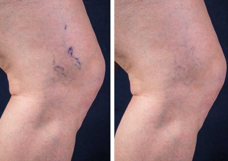Before and After Image: Sclerotherapy - right-side