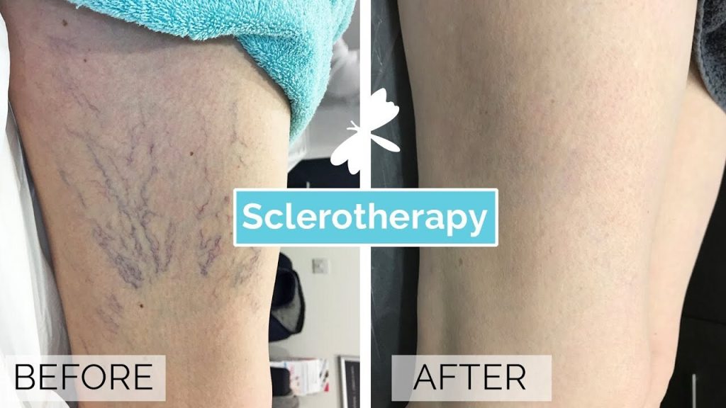 Before and After Image: Sclerotherapy - right-back-oblique