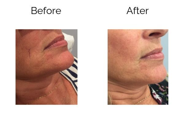 Before and After Image: Sclerotherapy - right-side