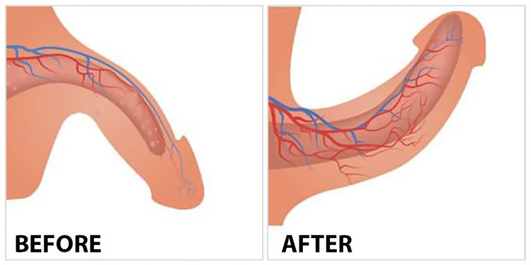 Before and After Image: Sexual Rejuvenation – Men - front