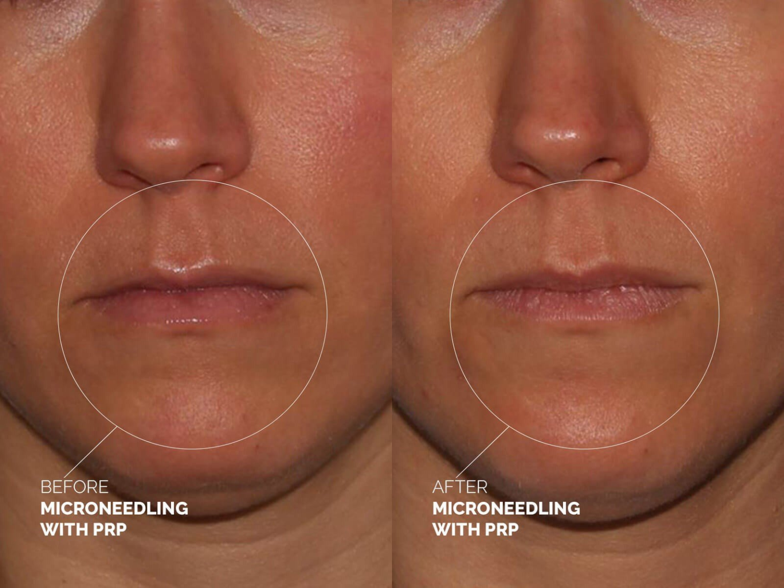 Before and After Image: Microneedling - front