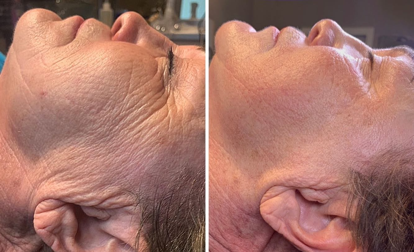 Before and After Image: Microneedling - other