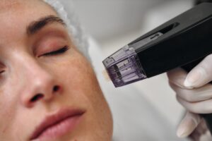 Close up of a woman receiving Morpheus8 treatment to her face to treat fine lines and wrinkles